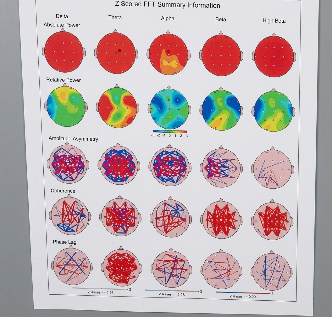 Meditative State B — topographic head map · 700+ μV